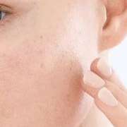 acne-banner