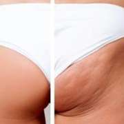 combattere-cellulite_polyporus